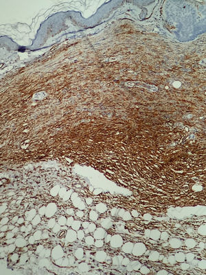 Immunohistochemistry of the lesion positive for CD34 (X4)