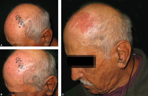 A - Clinical aspect before treatment. B - Three months after treatment, when biopsies were performed. C - One year after treatment, with complete clearance of the scalp lesions