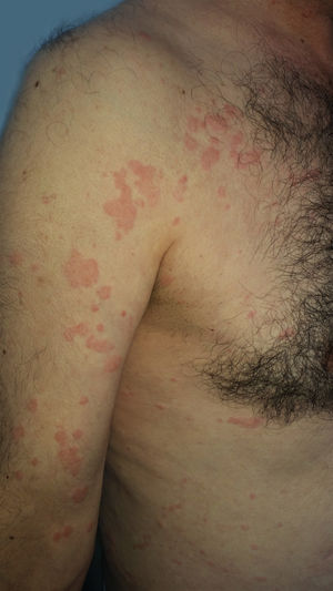 Exacerbation of the urticaria after omalizumab administration in the patient