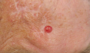 Shiny, erythematous papule with a central depression on the patient’s forehead