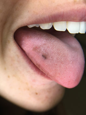 Lingual melanotic macule – the first case report in an adult patient*