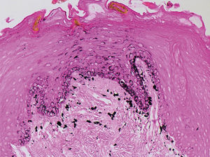 Lingual melanotic macule – the first case report in an adult patient*
