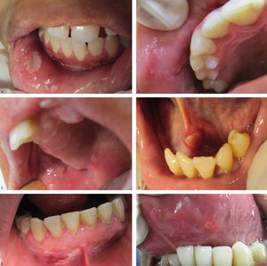 Anatomical sites of RAS. a: Lower lip (Major RAS), b: Upper lip (Minor RAS), c: Buccal mucosa and soft palate (Herpetiform RAS), d: Floor (Major RAS), and: Oral vestibule (Major RAS) and f: Tongue (Minor RAS)