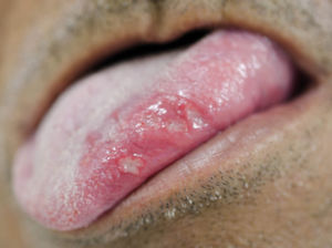 Major RAS on the left lateral border of the tongue