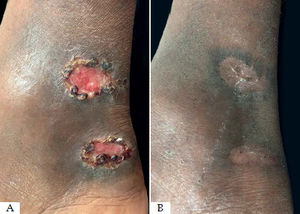 A - Before treatment with thermotherapy. B - After treatment with thermotherapy (only the larger lesion was treated)