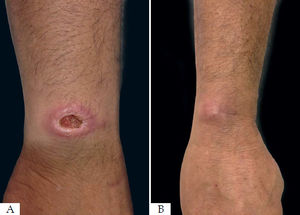 A - Before treatment with thermotherapy. B - After treatment with thermotherapy