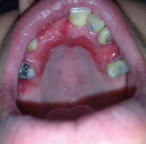 Atrophic candidiasis on the anterior palate