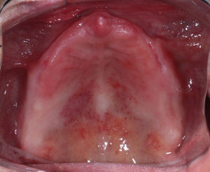 Atrophic candidiasis on the posterior palate