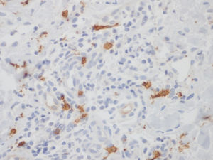 Fragment of skin showing mast cells stained with C-kit (CD 117) in a 40x field