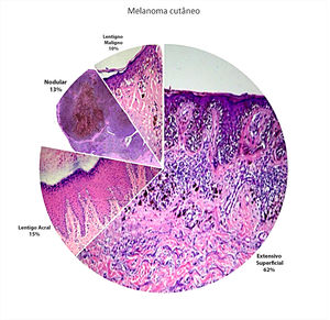 Distribution of the histological subtypes in the population studied (Hematoxylin & eosin slides)