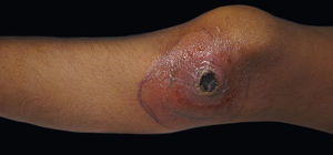 Ecthyma gangrenosum-like due to aspergillosis in a 6-year-old immunosuppressed patient