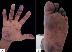 A and B- Disseminated ecchymotic purpura in a male patient with meningoccocemia