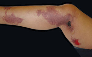 Purpuric plaques with necrosis in patient with calciphylaxis