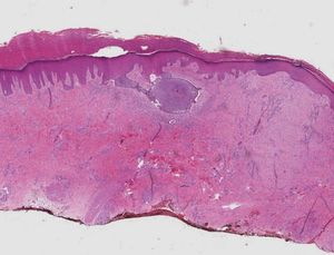 Panoramic photomicrograph of histological section demonstrating basaloid neoplasm in a nodular arrangement adjacent to the squamous epithelium and surrounded by inflammatory reaction. Note the presence of ulceration on the lesion’s surface. (Hematoxylin & eosin, X40)
