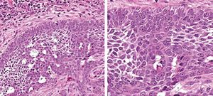 Photomicrographs of the histological section in detail demonstrating A - the typical peripheral palisade of the tumor nest (Hematoxylin & eosin, X400) and B - the basaloid cells ( Hematoxylin & eosin, X1000)
