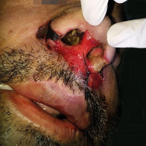 Destruction and perforation of the nasal septum