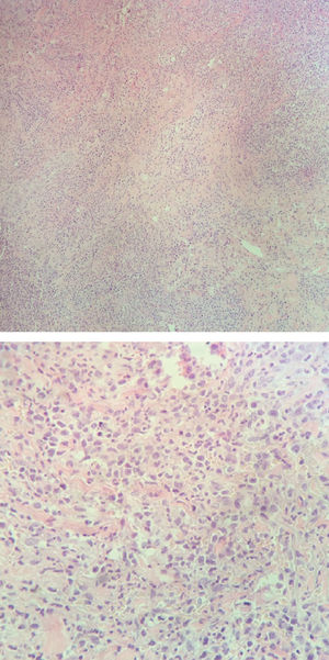A - Infiltrate of atypical small and medium-sized lymphoid cells in the deep dermis (Hematoxylin & eosin, x100). B - Some large pleomorphic lymphocytes (Hematoxylin & eosin, X400)