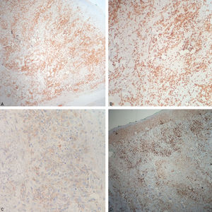 Immunohistochemistry: A - positive for CD3; B - positive for granzyme B; C - weakly positive for CD56; D - elevated index of cellular proliferation by Ki-67 (70%)