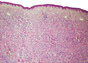 Preserved epidermis. In the reticular dermis we can observe the presence of an epithelial neoplasia with cells with pink cytoplasm and large nuclei organized in masses, resembling ducts (Hematoxylin & eosin, X2,5)