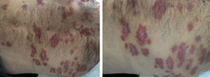 Erythematous and scaly plaques and papules over the entire surface of the body