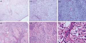 histopathological findings of skin tissue biopsy (top row) and axillary lymph node biopsy (arrow shows emperipolesis) Hematoxylin & eosin, X10-X400