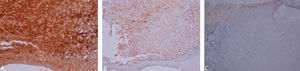 Immunohistochemistry, X10; findings of A - S100, B - CD68, and C - CD1a proteins
