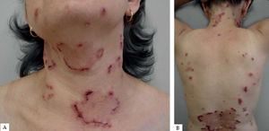Vesicles and hemorrhagic crusts with an arciform configuration on the anterior cervical region (A) and posterior cervical region and on the back (B)