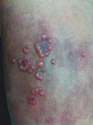 Tense vesicles and blisters with serous content on the back, with some on the periphery of previous lesions, setting up a rosette appearance