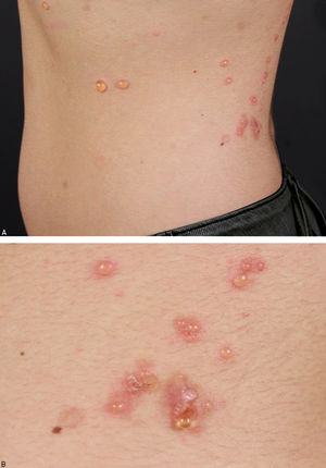Lesions on the trunk: tense vesicles and bullae with serous content, some on an erythematous base (A); detail of lumbar region (B)
