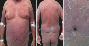 Patient with erythrodermic psoriasis and HIV infection of recent diagnosis. Purple-erythematous plaques with fine scaling extend from trunk to upper and lower extremities