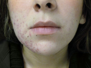 Predominance of acne lesions on the right side of the face