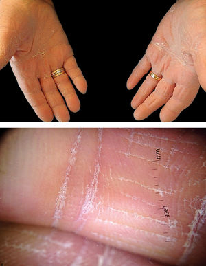 Clinical examination shows diffuse white scaling involving the palmar surface and the volar aspect of the fingers of both hands (A). Polarized light dermoscopy reveals white scaling mainly located in the creases (B)