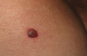 Clinical photograph of clear cell acanthoma. Nodular brown lesion with erythema located on the left buttock