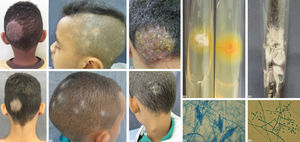 Tinea capitis clinical forms: alopecic microsporosis (A1 and A2); alopecic trichophytosis (B1 and B2); andkerion Celsi (C1 and C2) – arrow indicating reactional lymph node enlargement, typical of this presentation. Fungal culture of the main isolated agents: Microsporum canis macroculture showing white, cottony colonies with a bright-yellow reverse (D1) and microculture with hyaline septate hyphae and spindle-shaped macroconidia with more than 6 septa inside them (D2); Trichophyton tonsurans macroculture with powdery, brownish and cerebriform colonies (E1) and microculture with hyaline septate hyphae and interspersed microconidia (E2)