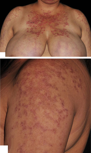 Sun-exposed areas with erythematous, annular, exulcerated, and scaly plaques before treatment with rituximab (RTX)