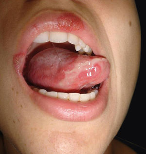 Blisters and ulcerations on the tongue and lips