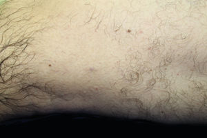 Violaceous papule on the left thigh