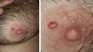 A - An erythematous papule on left areola. B - Detail of the lesion