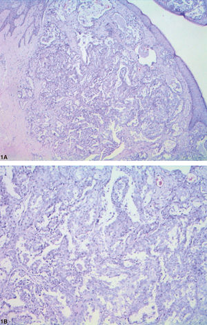 A - Microscopic examination: dermal tumor with papillary folds and no connection to the overlying epidermis (Hematoxylin & eosin, X100). B - Lumen lined by columnar cells with decapitation secretion. (Hematoxylin & eosin, X400)