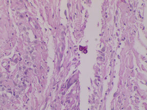 Chromoblastomycosis. Medlar bodies (PAS, X10)