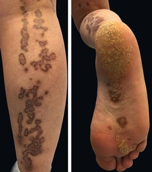 Deep red to brownish, atrophic plaques with a prominent peripheral hyperkeratotic ridge, coalescing on the lower right limb, including the sole and assuming a linear distribution, following the Blaschko lines
