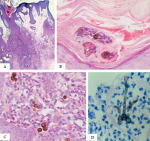 Histological features. A - Pseudoepitheliomatous hyperplasia, hyperparakeratosis, and dermis with edema and granulomatous inflammatory infiltrate (Hematoxylin & eosin, x40); B - Muriform cells in the stratum corneum with transdermal elimination(Hematoxylin & eosin, x400); C - Suppurated granuloma with muriform bodies inside giant cells (Hematoxylin & eosin, x400); D - Muriform cells and septated hyphae in abscess (Fite-Faraco staining) x100