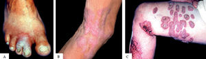 CBM lesions according to severity criteria.A - mild; B - moderate; C - severe
