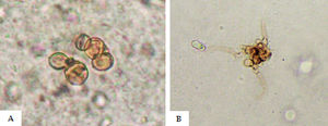 Direct mycologic examination. A - muriform bodies; B - Muriform bodies and dematiaceous hyphae
