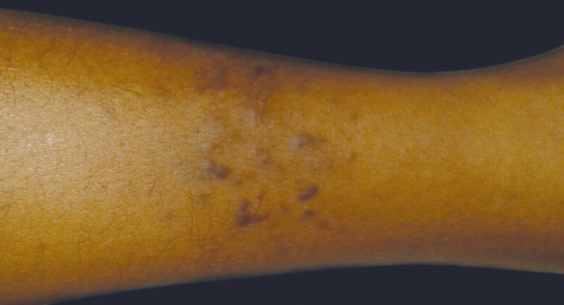 Hiv Black Skin