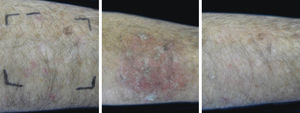 D1, D7, and D57 on forearm treated for two days with IM 0.05%. On D1 there were six AK lesions, while on D57 there was one lesion. On D7, intense erythema, desquamation, and crusting