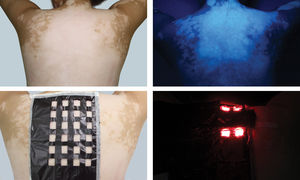 (A) Large white patch on the patient’s back before treatment. (B) Bright white under Wood’s light. (C) PDT preparations for treating vitiligo. (D) Operation of irradiation during experiment