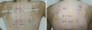 (A) Immediate reactions after irradiation, post-treatment erythema labeled by arrow. (B) Perifollicular red papules at 24h after irradiation labeled by arrow