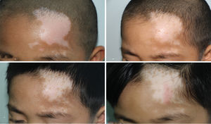 (A) Before treatment (August 7, 2015); (B) Pigment islands found after three treatments (October 22, 2015); (C) Pigment islands near hairline (March 7, 2016); (D) Increase in pigment islands near hairline (June 27, 2016)
