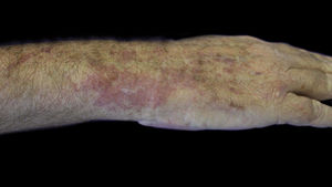 Slightly raised erythematous lesion, with irregular border, measuring about 8 cm in diameter